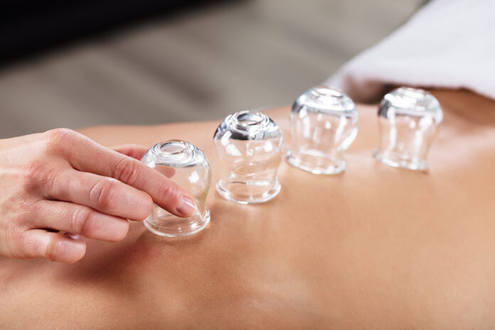 Cupping therapy Melbourne