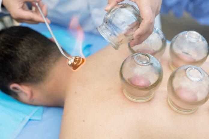 Cupping treatment melbourne